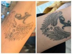 Nach 1 Tattooentfernung